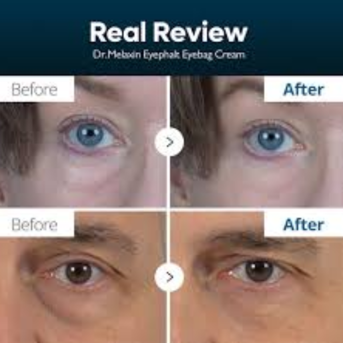 Dr. Melaxin Eyephalt - Κρέμα Ματιών για Σακούλες & Μαύρους Κύκλους 10ml