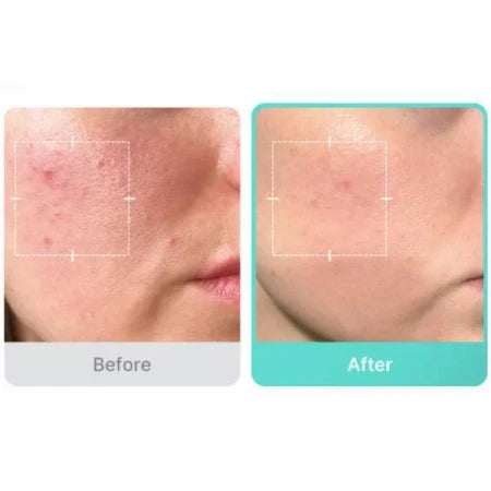 Medicube Azelaic Acid 16 BB Καταπραϋντικό Serum Προσώπου για Ερυθρότητα, Ατέλειες και Σημάδια Ακμής30ml